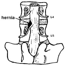 Hernia